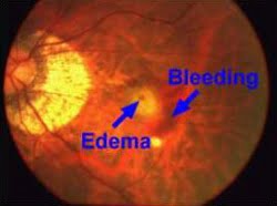Fundus Photo Fundus Photo