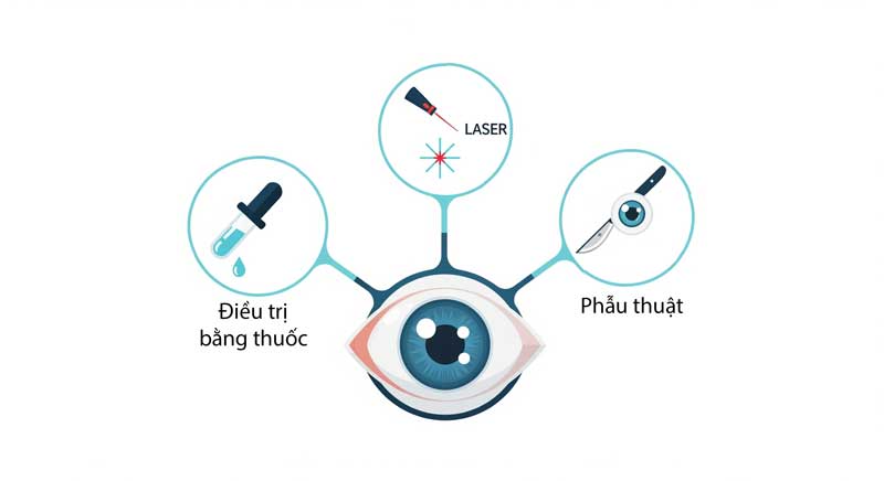 Các phương pháp điều trị bệnh tăng nhãn áp: thuốc nhỏ mắt, laser, và phẫu thuật