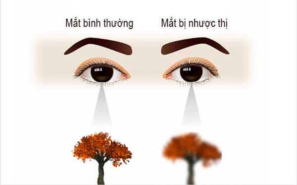 Sơ đồ minh họa giữa mắt thường và mắt bị bệnh nhược thị