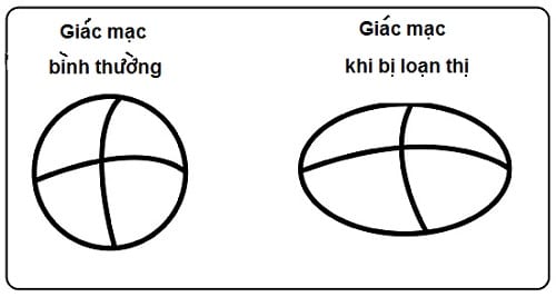 Sơ đồ so sánh giác mạc của mắt bình thường và mắt bị loạn thị