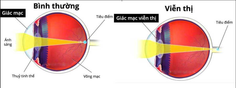 Sơ đồ so sánh mắt bình thường và mắt bị viễn thị